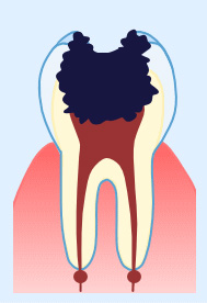 虫歯の進行