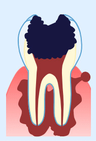 虫歯の進行