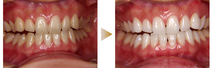 ホワイトニング
