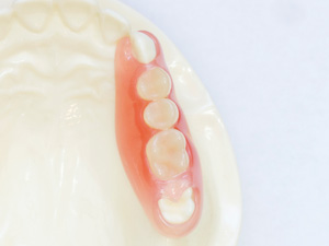 ノンクラスプデンチャー