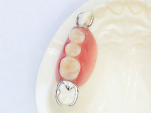 クラスプデンチャー